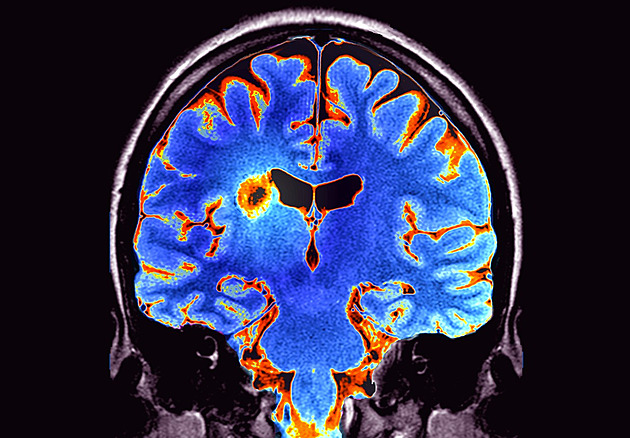 Roztroušená skleróza: nemoc, která zasahuje mozek i míchu. Jak ji poznat?